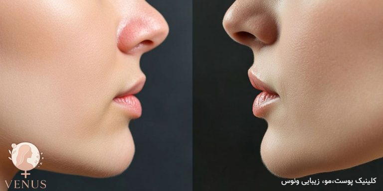 فیلر چانه در فردیس