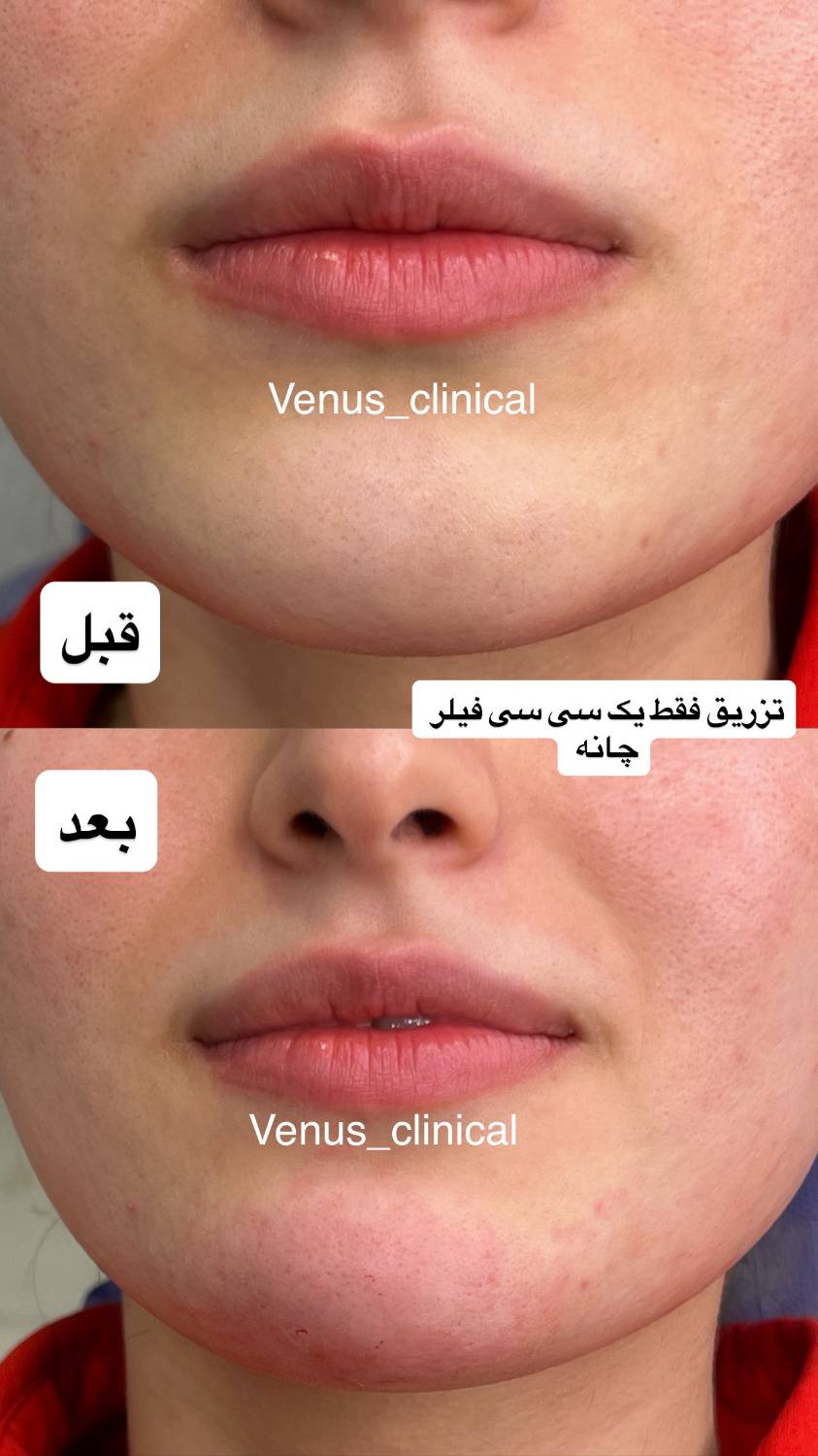 نمونه کار فیلر چانه در فردیس
