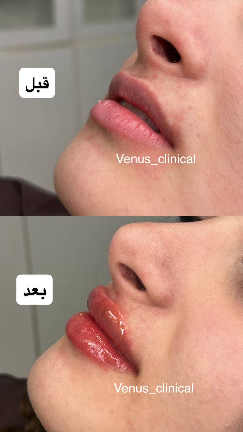 نمونه کار فیلر لب در فردیس