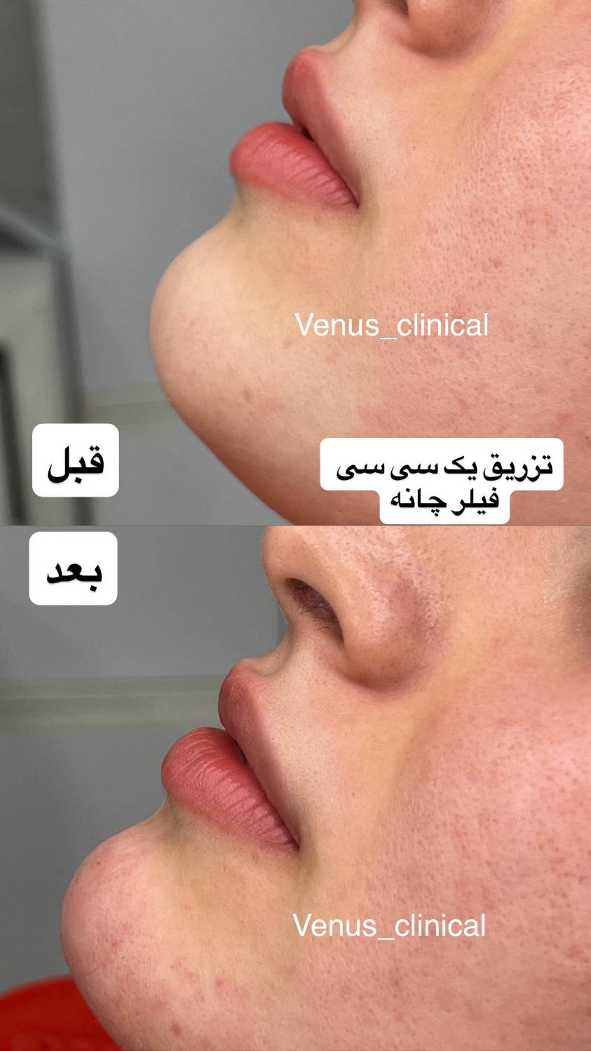فیلر چانه در فردیس