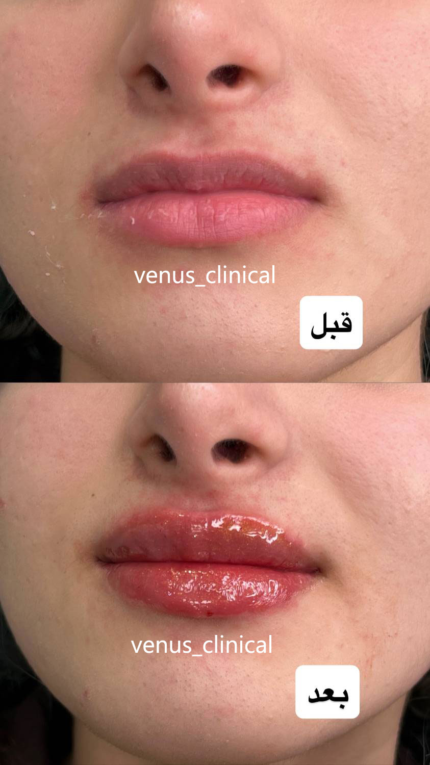 نمونه کار فیلر لب در فردیس